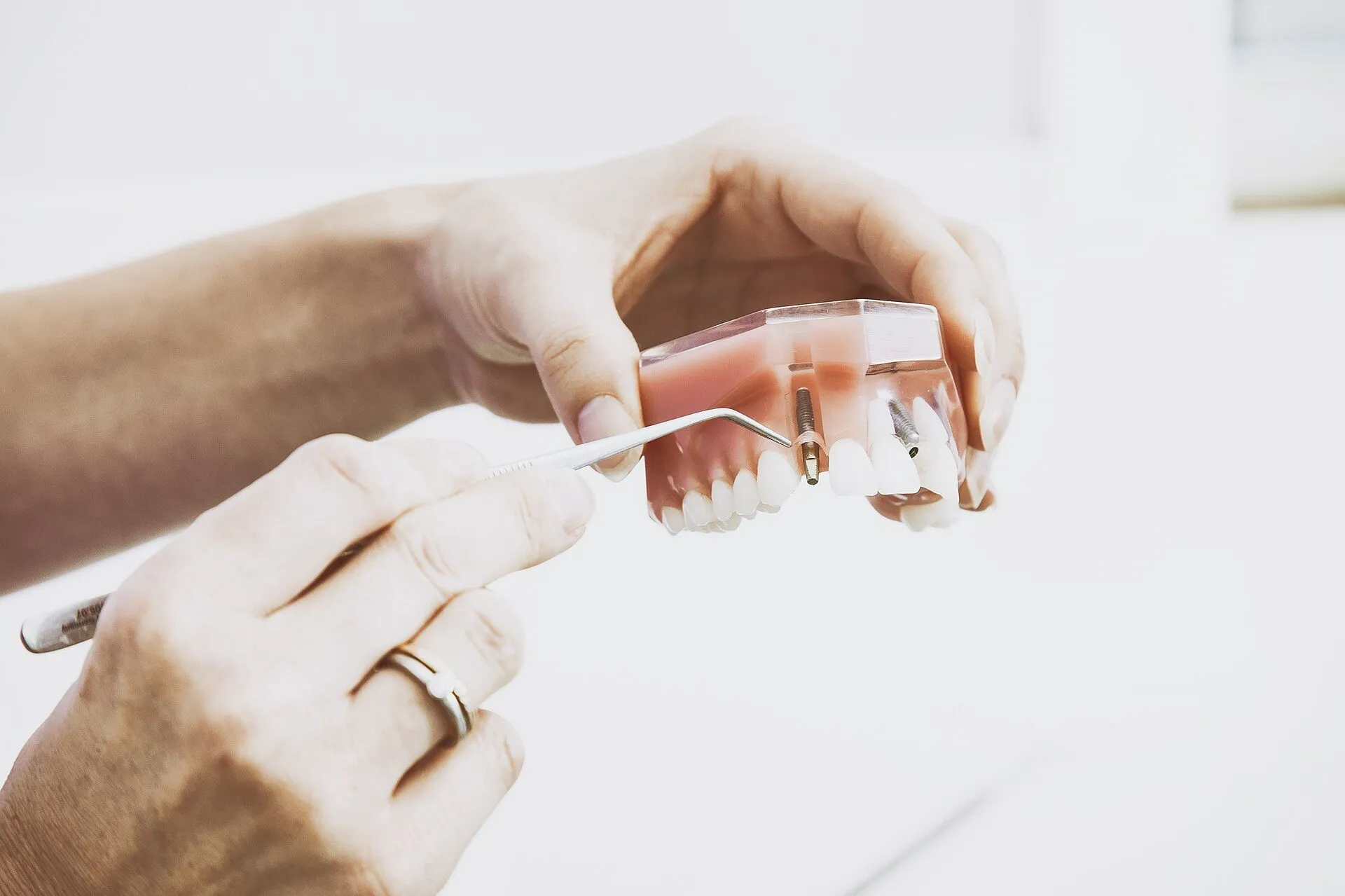 Hände zeigen an einem Kiefermodell, wie ein Implantat sitzt